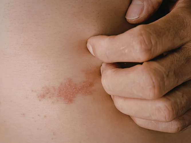 Shingles